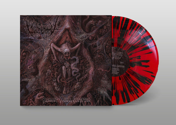VULVECTOMY - Aberrant Vaginal Gestation - LP
